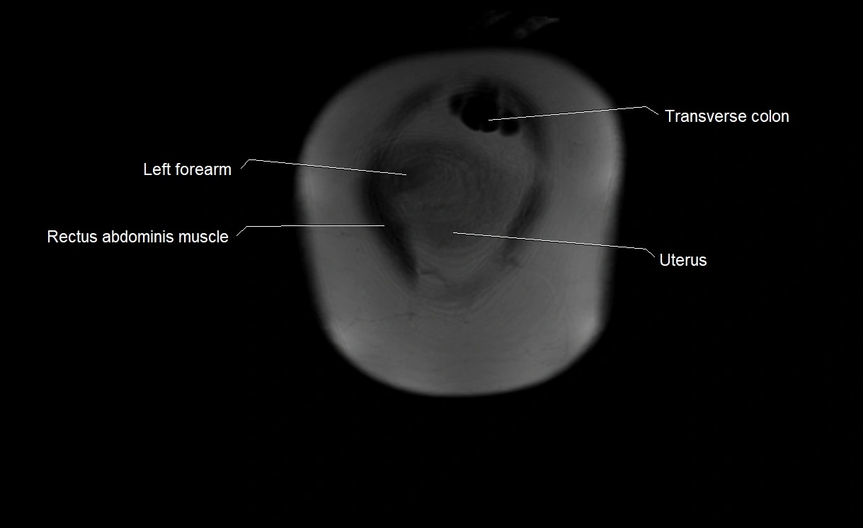 MRI Anatomy of pregnancy image 2.webp